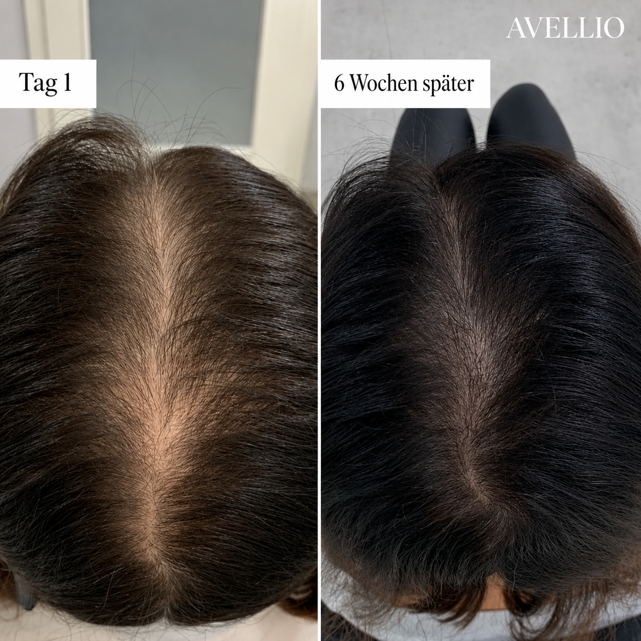 Avellio™ Haarwuchs System