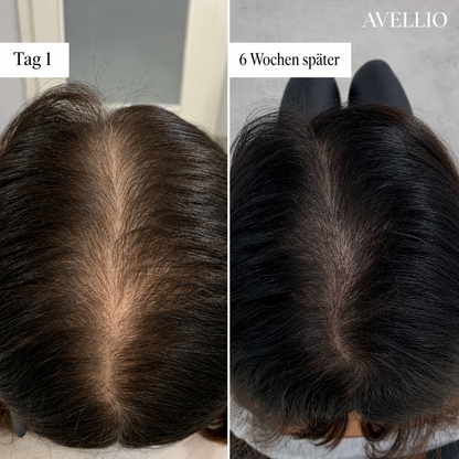 Avellio™ Haarwuchs System