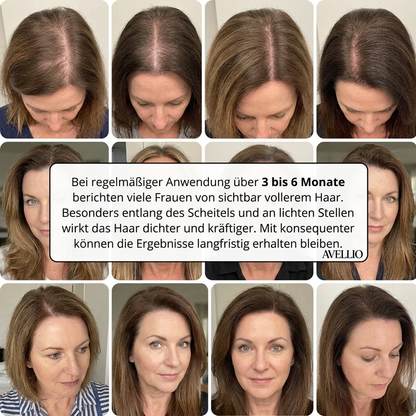 Avellio™ Haarwuchs System